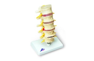 Model skoliózy chrbtice